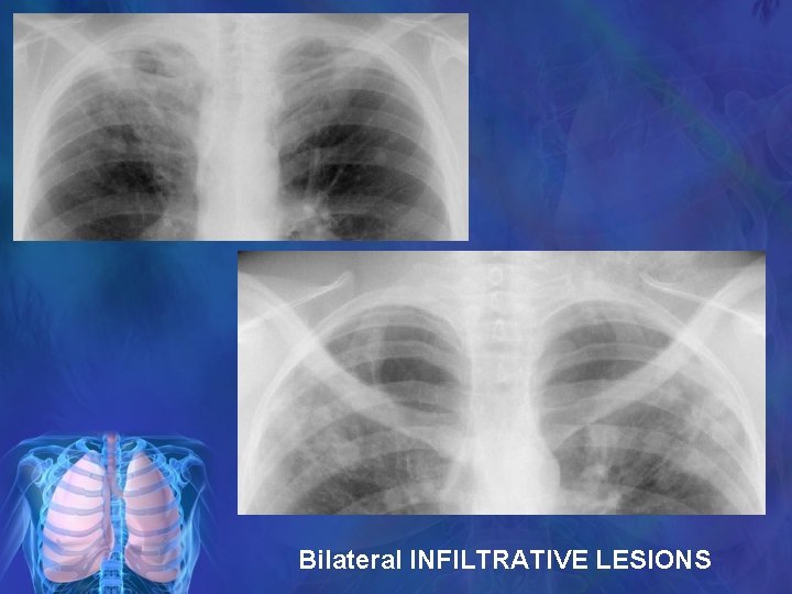 Bilateral INFILTRATIVE LESIONS 