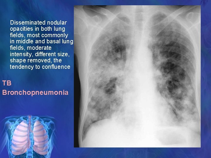 Disseminated nodular opacities in both lung fields, most commonly in middle and basal lung