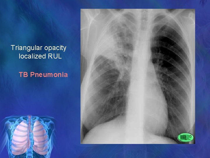 Triangular opacity localized RUL TB Pneumonia 
