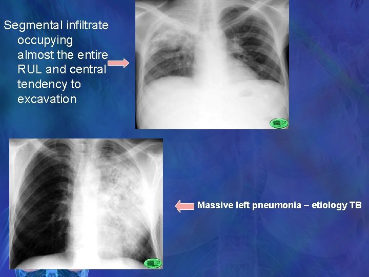 Segmental infiltrate occupying almost the entire RUL and central tendency to excavation Massive left