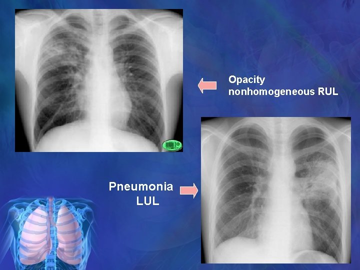 Opacity nonhomogeneous RUL Pneumonia LUL 