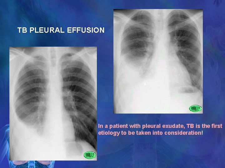 TB PLEURAL EFFUSION In a patient with pleural exudate, TB is the first etiology