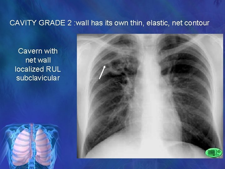 CAVITY GRADE 2 : wall has its own thin, elastic, net contour Cavern with
