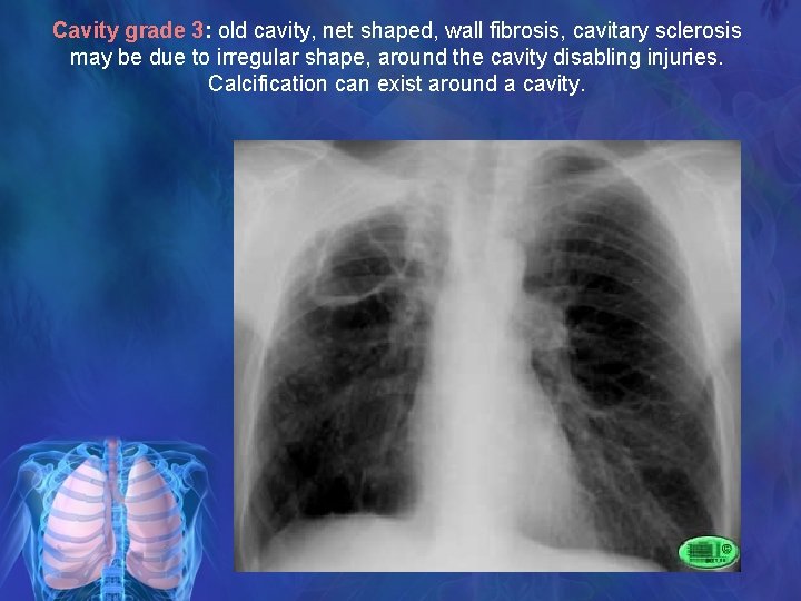 Cavity grade 3: old cavity, net shaped, wall fibrosis, cavitary sclerosis may be due