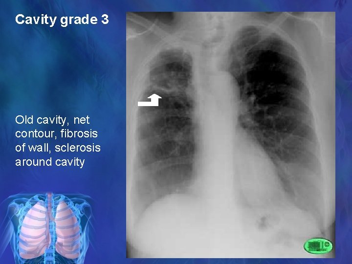 Cavity grade 3 Old cavity, net contour, fibrosis of wall, sclerosis around cavity 
