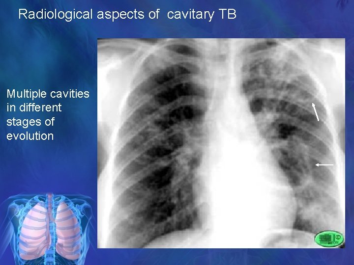 Radiological aspects of cavitary TB Multiple cavities in different stages of evolution 