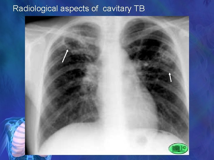 Radiological aspects of cavitary TB 