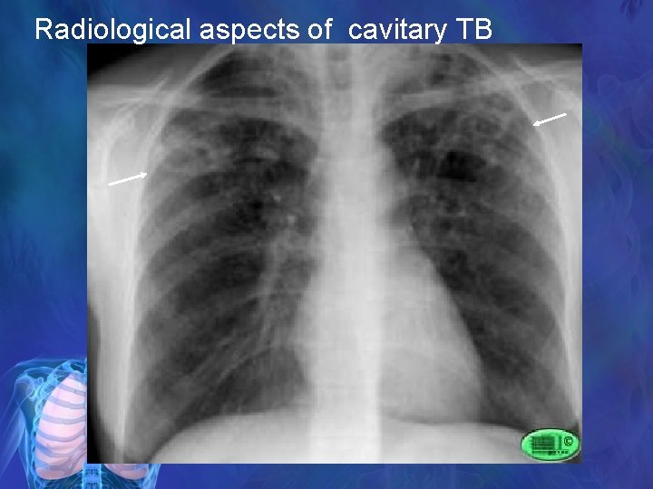 Radiological aspects of cavitary TB 