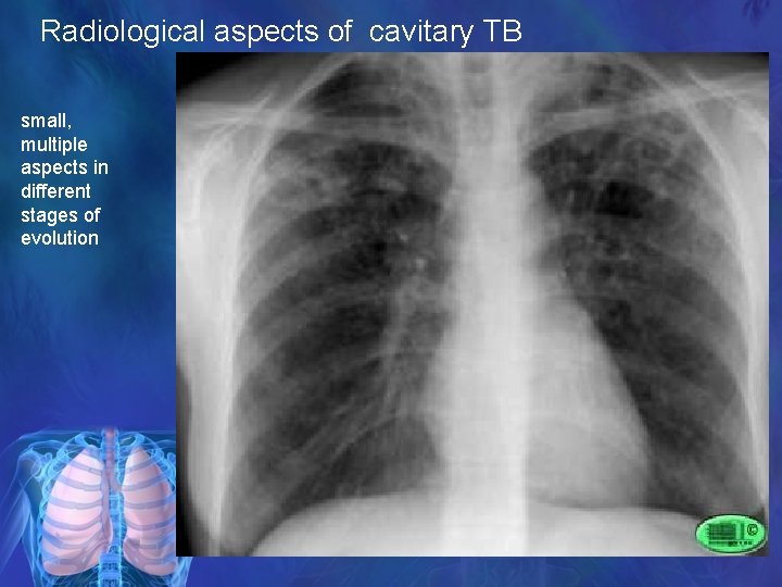 Radiological aspects of cavitary TB small, multiple aspects in different stages of evolution 