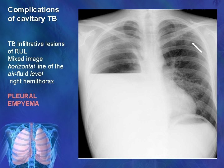 Complications of cavitary TB TB infiltrative lesions of RUL Mixed image horizontal line of
