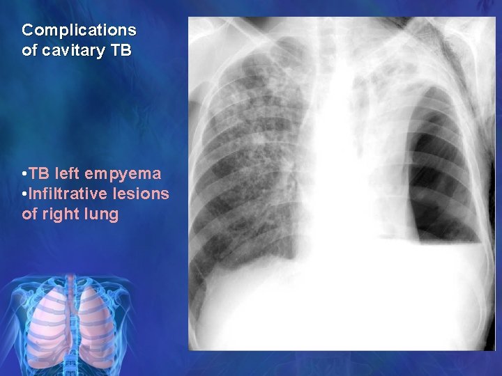 Complications of cavitary TB • TB left empyema • Infiltrative lesions of right lung