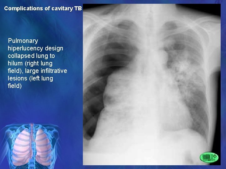 Complications of cavitary TB Pulmonary hiperlucency design collapsed lung to hilum (right lung field),