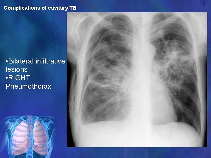 Complications of cavitary TB • Bilateral infiltrative lesions • RIGHT Pneumothorax 