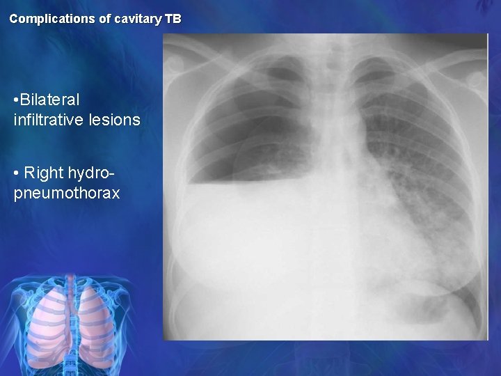 Complications of cavitary TB • Bilateral infiltrative lesions • Right hydropneumothorax 