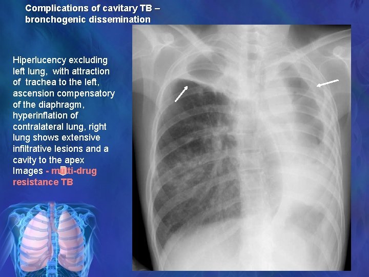 Complications of cavitary TB – bronchogenic dissemination Hiperlucency excluding left lung, with attraction of