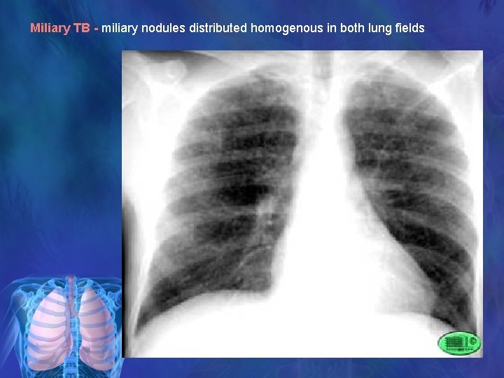Miliary TB - miliary nodules distributed homogenous in both lung fields 