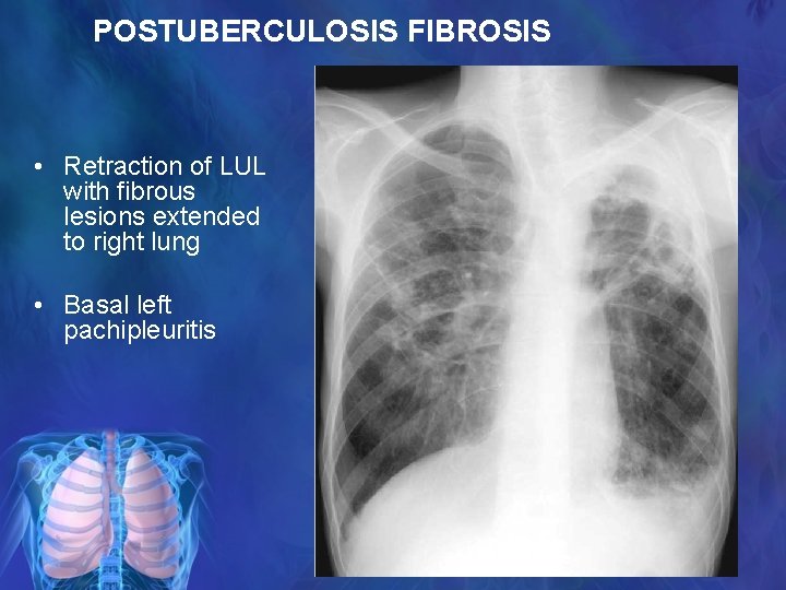 POSTUBERCULOSIS FIBROSIS • Retraction of LUL with fibrous lesions extended to right lung •