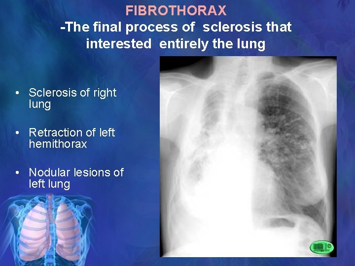 FIBROTHORAX -The final process of sclerosis that interested entirely the lung • Sclerosis of