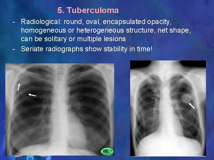 5. Tuberculoma - Radiological: round, oval, encapsulated opacity, homogeneous or heterogeneous structure, net shape,