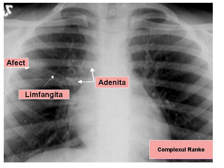 Afect Adenita Limfangita Complexul Ranke 