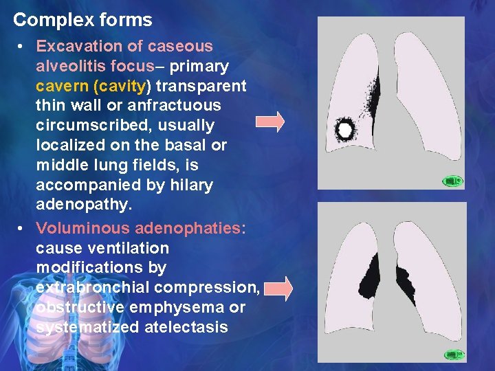 Complex forms • Excavation of caseous alveolitis focus– primary cavern (cavity) transparent thin wall
