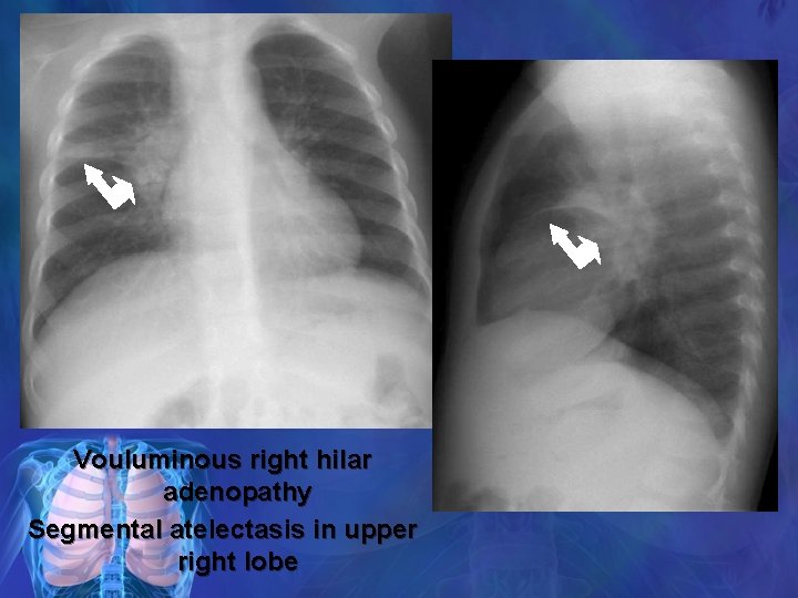 Vouluminous right hilar adenopathy Segmental atelectasis in upper right lobe 