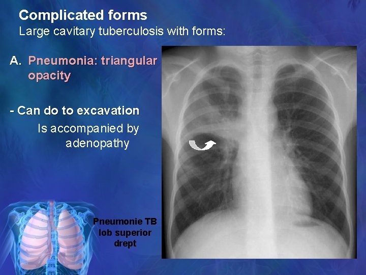 Complicated forms Large cavitary tuberculosis with forms: A. Pneumonia: triangular opacity - Can do