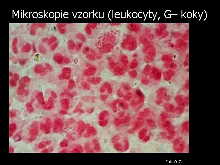 Mikroskopie vzorku (leukocyty, G– koky) Foto O. Z. 