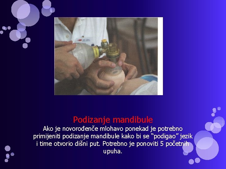 Podizanje mandibule Ako je novorođenče mlohavo ponekad je potrebno primijeniti podizanje mandibule kako bi