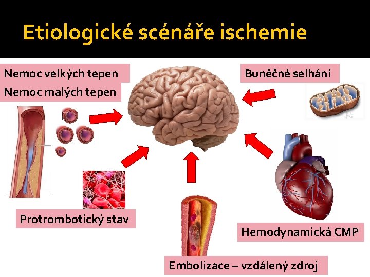 Etiologické scénáře ischemie Nemoc velkých tepen Buněčné selhání Nemoc malých tepen Protrombotický stav Hemodynamická