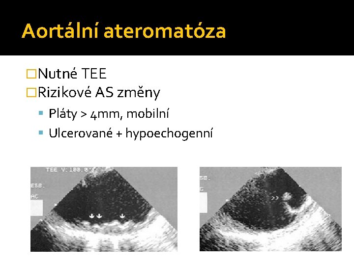 Aortální ateromatóza �Nutné TEE �Rizikové AS změny Pláty > 4 mm, mobilní Ulcerované +