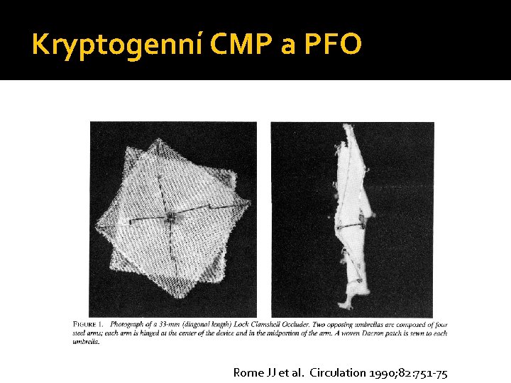 Kryptogenní CMP a PFO Rome JJ et al. Circulation 1990; 82: 751 -75 