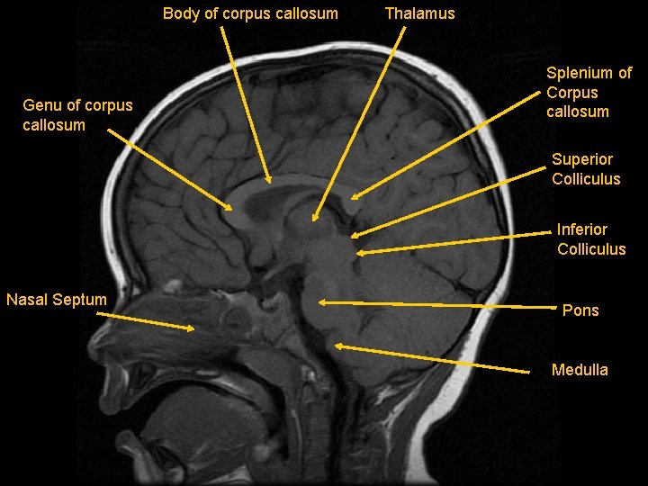 Body of corpus callosum Genu of corpus callosum Thalamus Splenium of Corpus callosum Superior