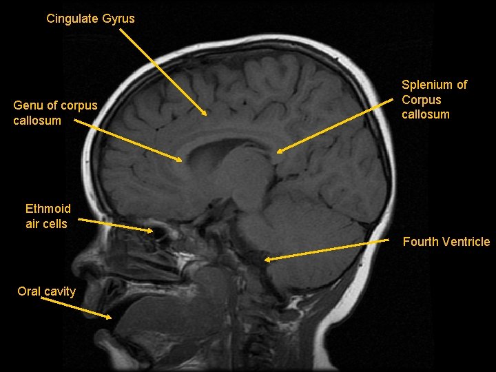 Cingulate Gyrus Genu of corpus callosum Splenium of Corpus callosum Ethmoid air cells Fourth
