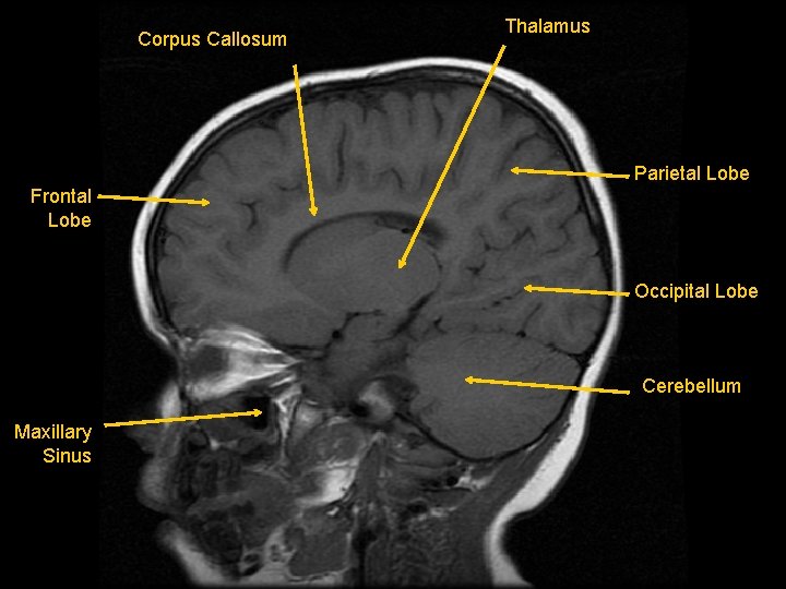 Corpus Callosum Thalamus Parietal Lobe Frontal Lobe Occipital Lobe Cerebellum Maxillary Sinus 