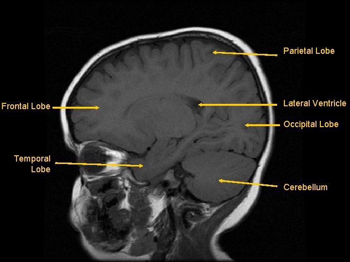 Parietal Lobe Frontal Lobe Lateral Ventricle Occipital Lobe Temporal Lobe Cerebellum 