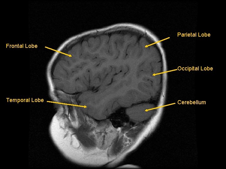 Parietal Lobe Frontal Lobe Occipital Lobe Temporal Lobe Cerebellum 