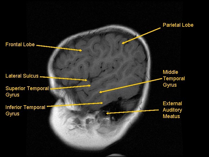 Parietal Lobe Frontal Lobe Lateral Sulcus Superior Temporal Gyrus Inferior Temporal Gyrus Middle Temporal