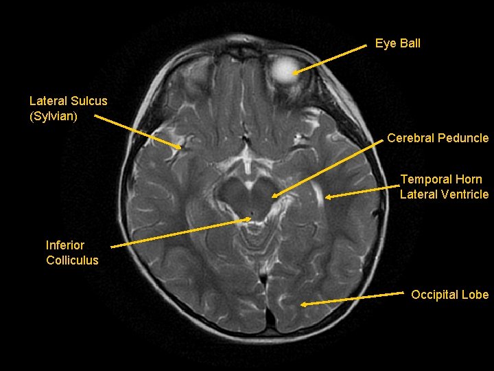 Eye Ball Lateral Sulcus (Sylvian) Cerebral Peduncle Temporal Horn Lateral Ventricle Inferior Colliculus Occipital