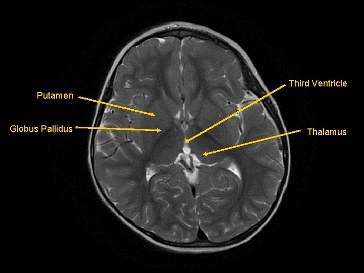 Third Ventricle Putamen Globus Pallidus Thalamus 