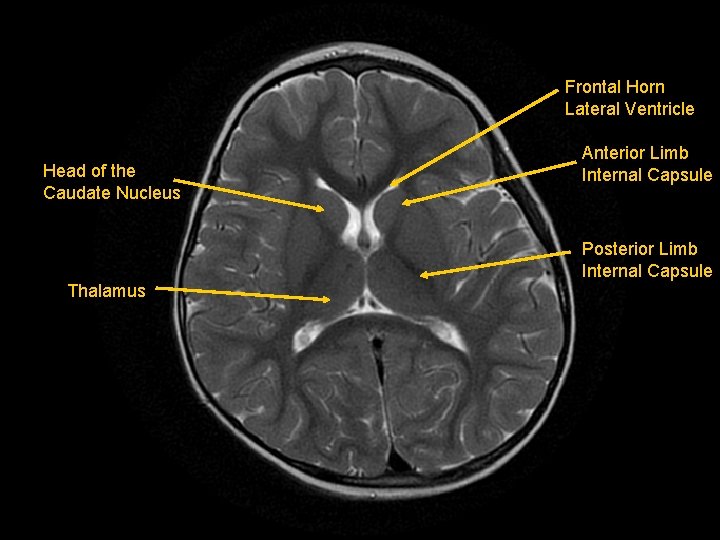 Frontal Horn Lateral Ventricle Head of the Caudate Nucleus Anterior Limb Internal Capsule Posterior