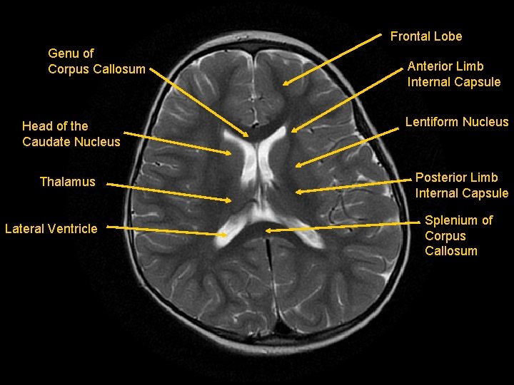 Frontal Lobe Genu of Corpus Callosum Head of the Caudate Nucleus Thalamus Lateral Ventricle