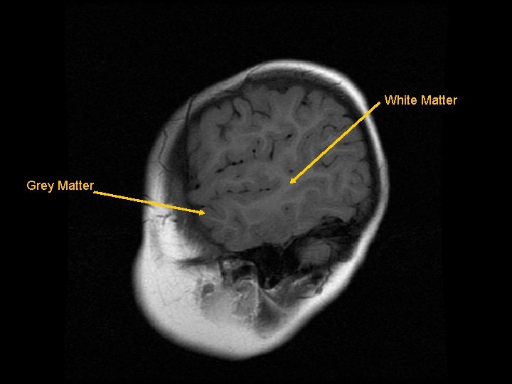 White Matter Grey Matter 