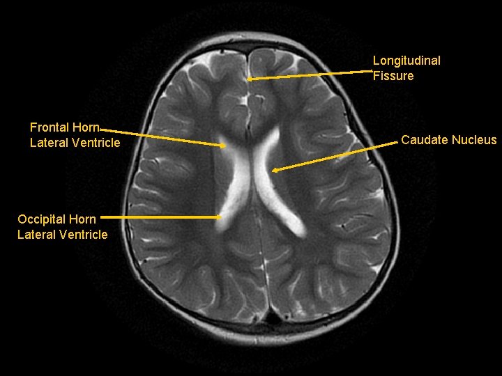 Longitudinal Fissure Frontal Horn Lateral Ventricle Occipital Horn Lateral Ventricle Caudate Nucleus 