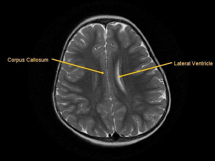 Corpus Callosum Lateral Ventricle 