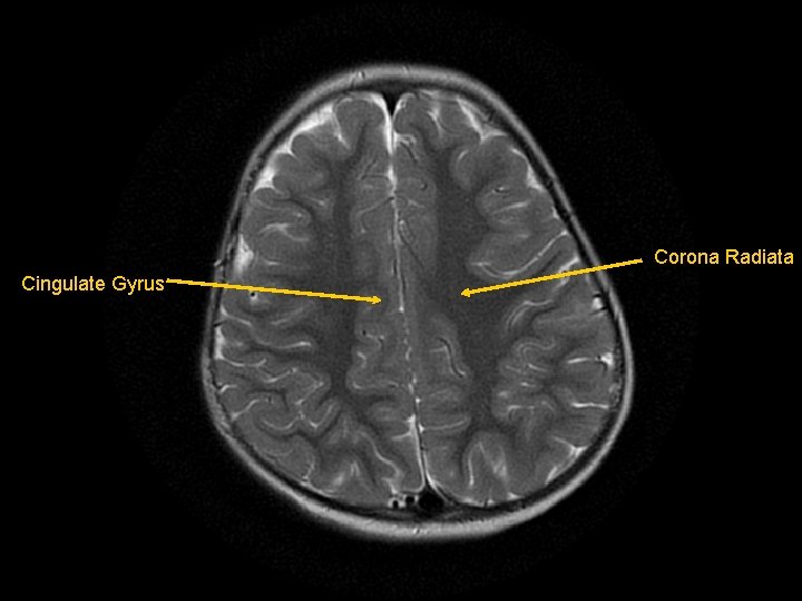 Corona Radiata Cingulate Gyrus 