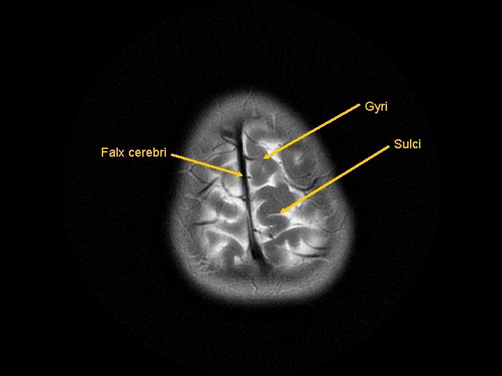 Gyri Falx cerebri Sulci 