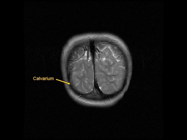 Calvarium 