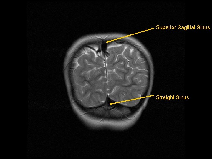 Superior Sagittal Sinus Straight Sinus 
