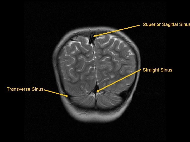 Superior Sagittal Sinus Straight Sinus Transverse Sinus 